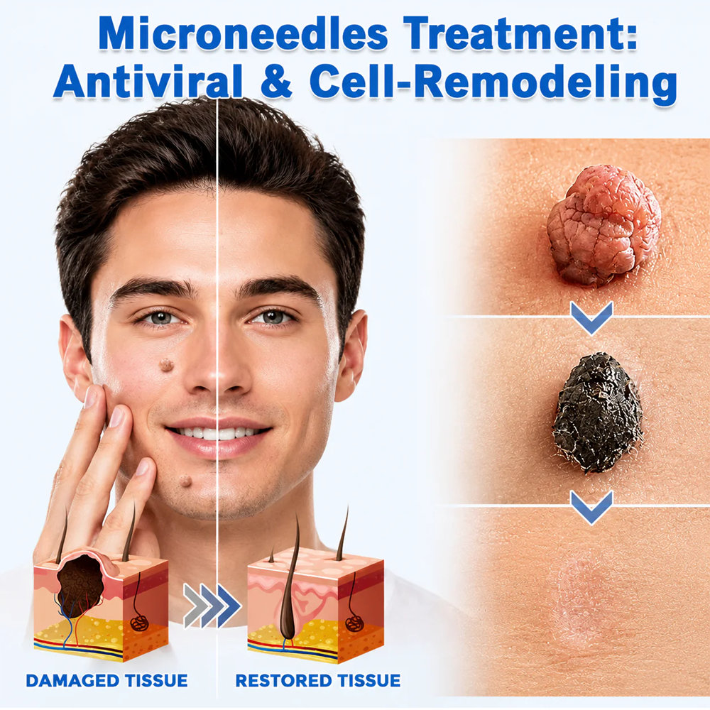 ✨Hiskin® 2-in-1 Microneedle & Hydrocolloid Patch🍀 | Removes raised moles, acne, flat warts, and skin tags | Helps improve wrinkles, scars, and blemishes | Invisible patches for face and body